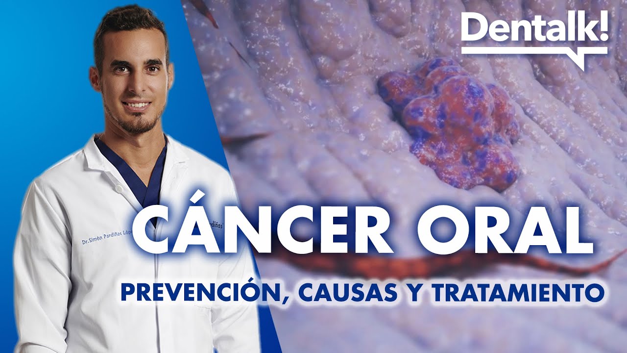 C&Aacute;NCER en la BOCA - S&iacute;ntomas, prevenci&oacute;n y tratamiento del c&aacute;ncer de LENGUA y ORAL | Dentalk! &copy;