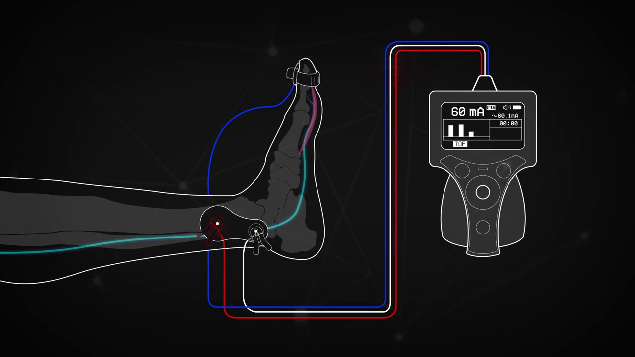 Train of Four Monitoring using the Posterior Tibial Nerve