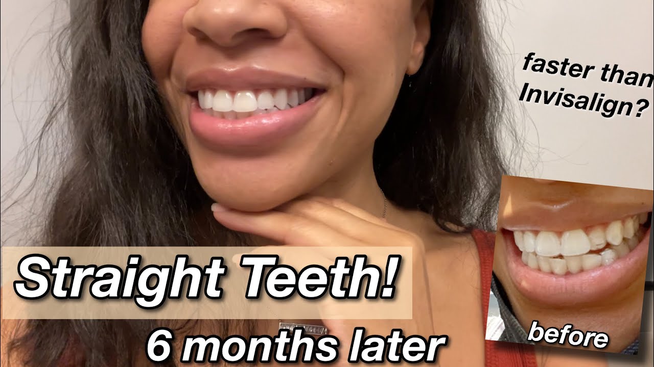 My six month experience with clear aligners | invisalign cheaper option | before and after results