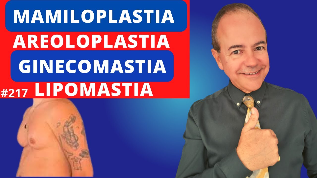 Ginecomastia, Lipomastia, Mamiloplastia, Areoloplastia [Dr. Jacintho - Cirurgi&atilde;o Pl&aacute;stico]