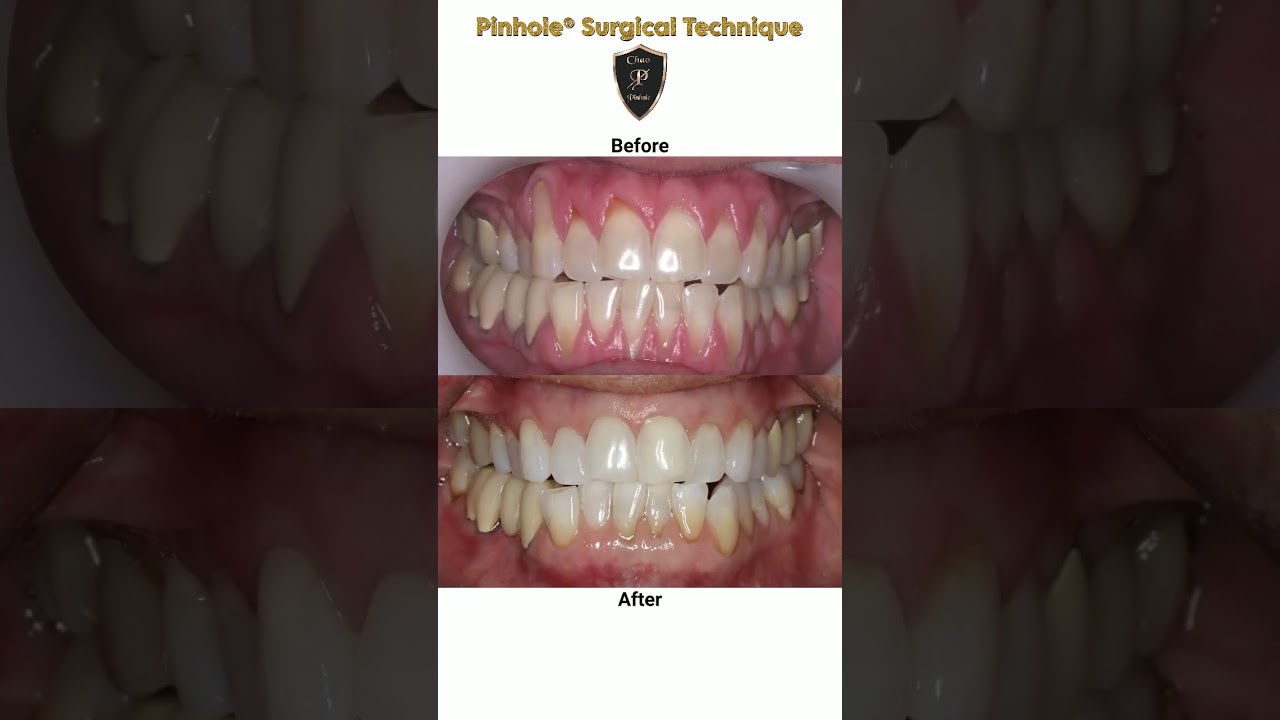 13-Year Pinhole® Surgery Transformation! Before & After #dentist #gumgraft #pinholesurgicaltechnique