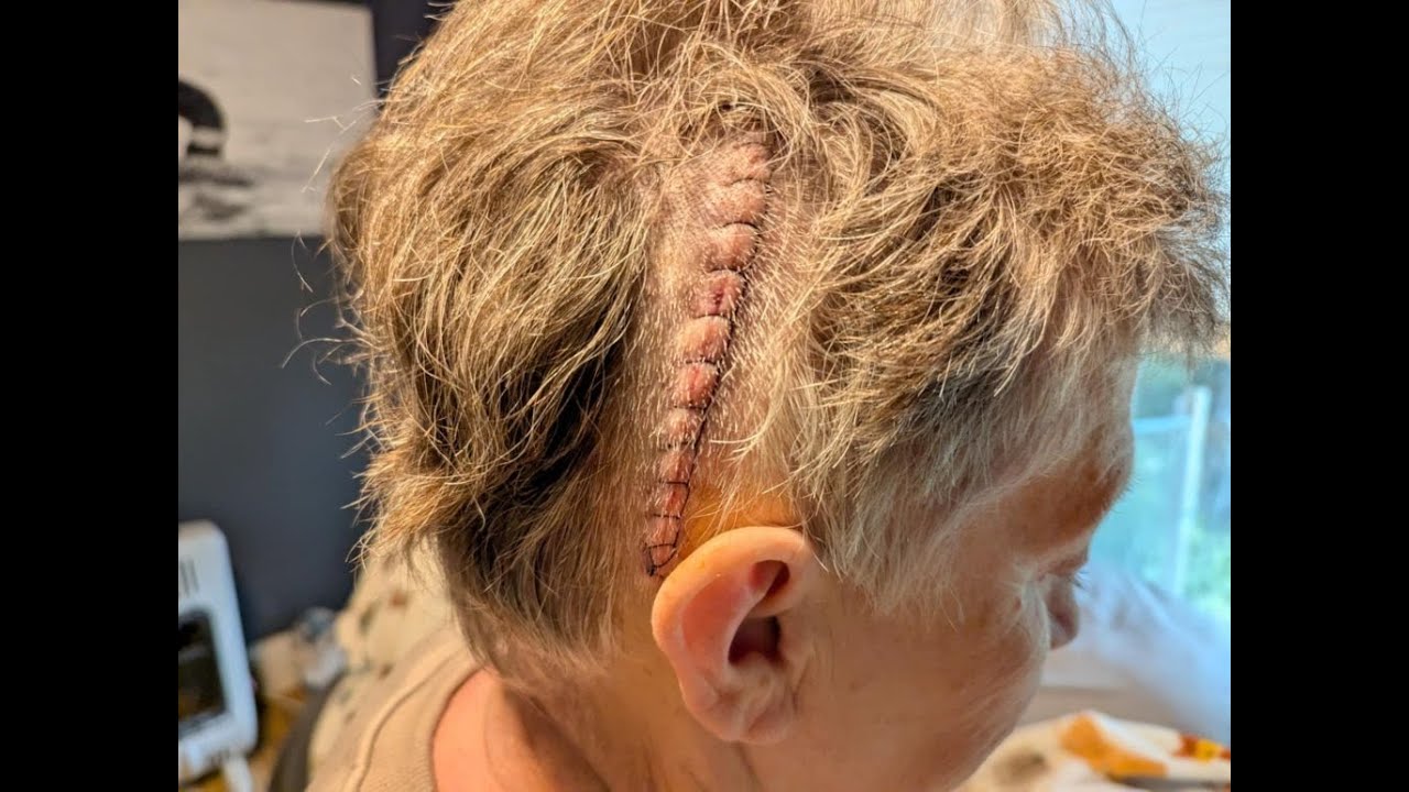 TUMOR ON BRAIN AND LUNG CANCER