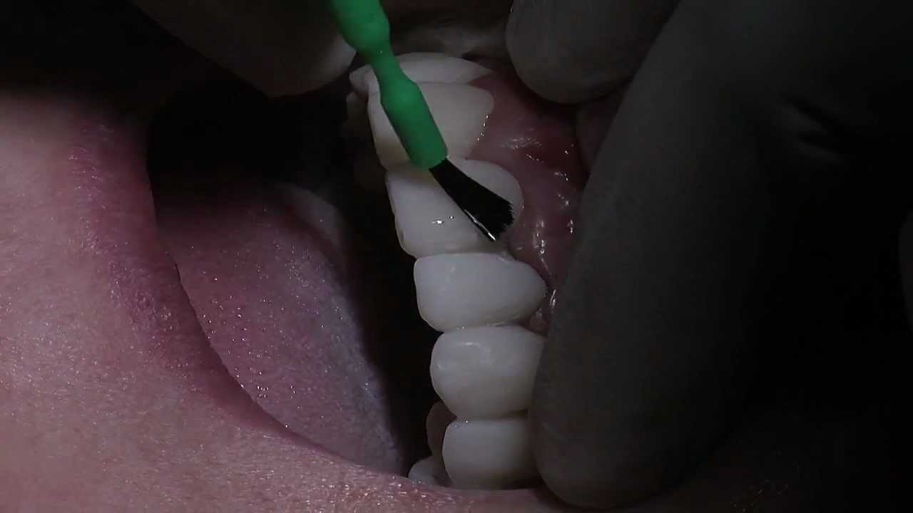 Smile make over with Dr. Parmar. Episode 11: glazing temporaries