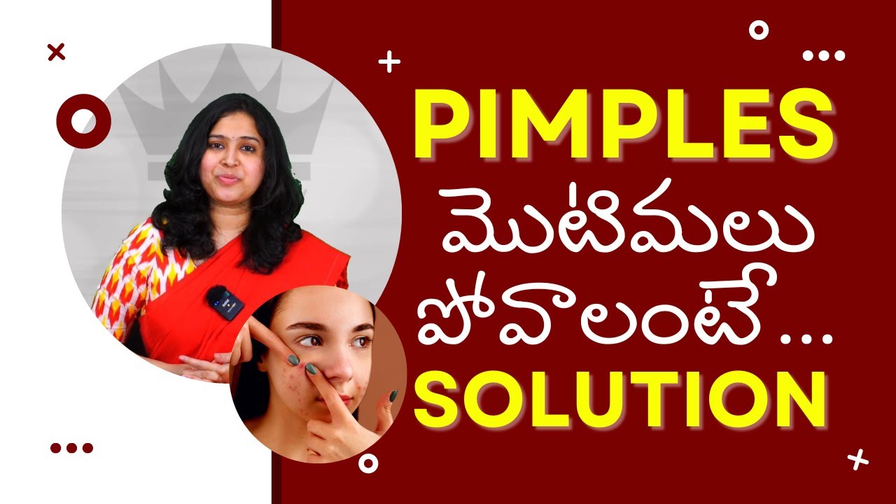 Pimple Solution by Dr. Deepthi | Diet for Acne in Telugu | Crowns Clinic