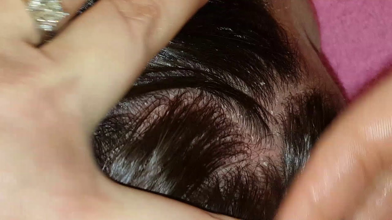 Part 2 psoriasis scalp scratching picking oil fingernails on my friend ASMR hair little talking