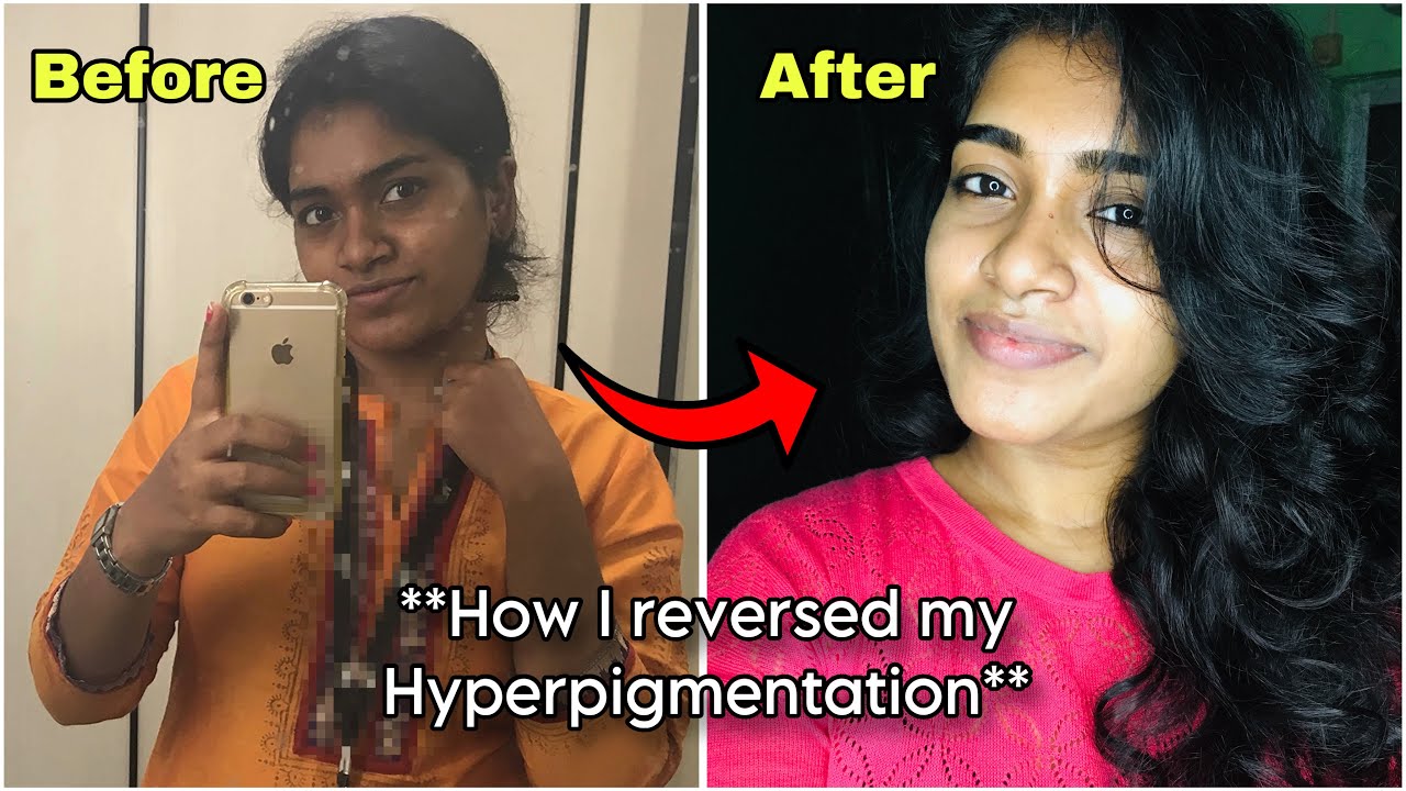 How I Reversed My Hyperpigmentation?? **With Products Details**
