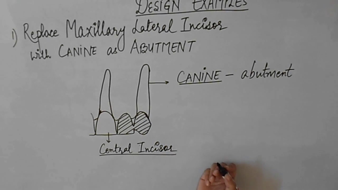Cantilever Fixed Partial Denture