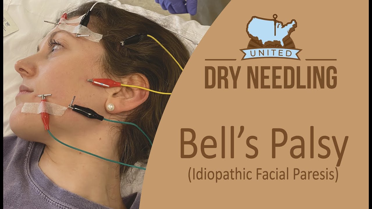 Treat Bell's Palsy with Needles!