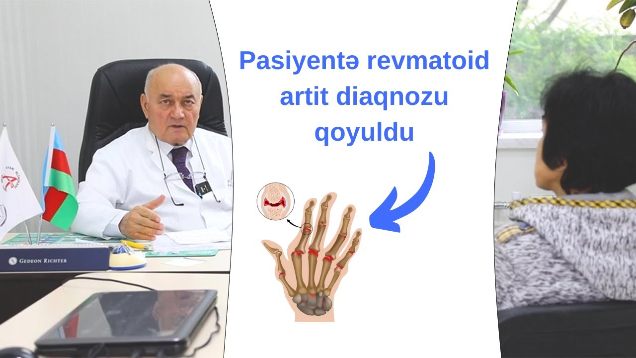 PASİYENTƏ REVMATOİD ARTRİT DİAQNOZU QOYULDU