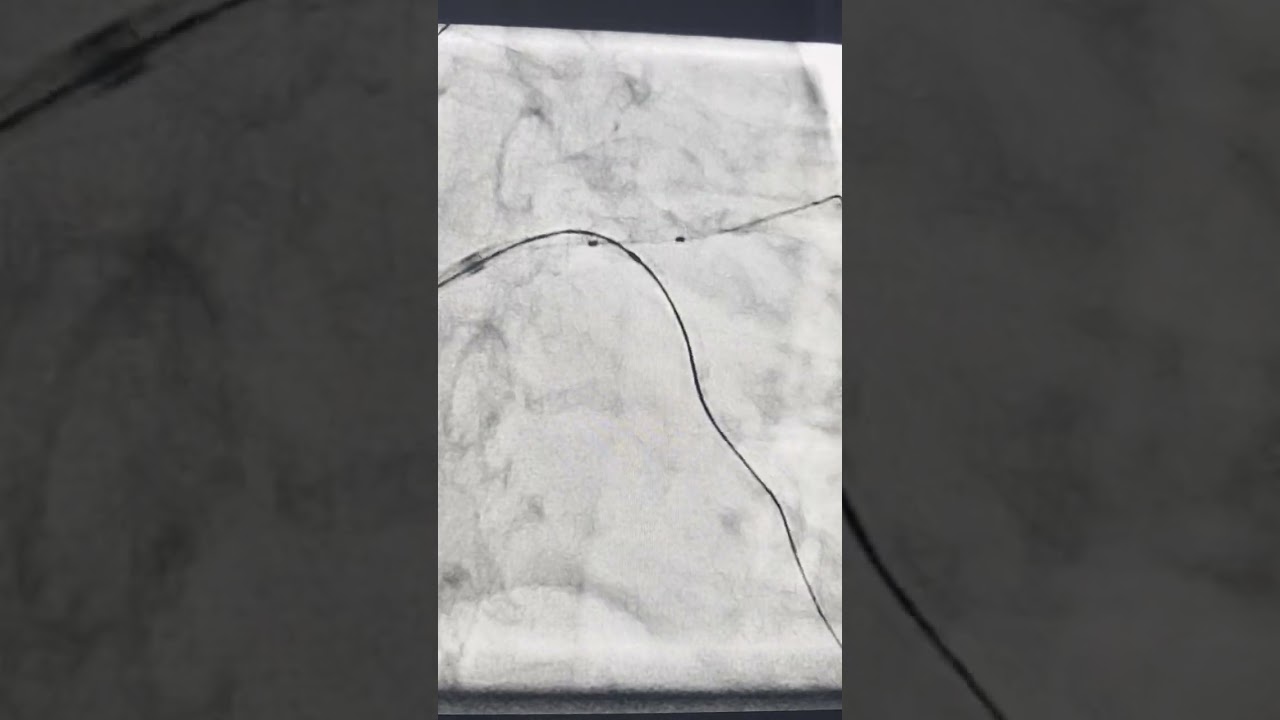 Case 20:  Very high risk , complex LM PCI in a 53 year old with occluded RCA ...A 6 stent case 