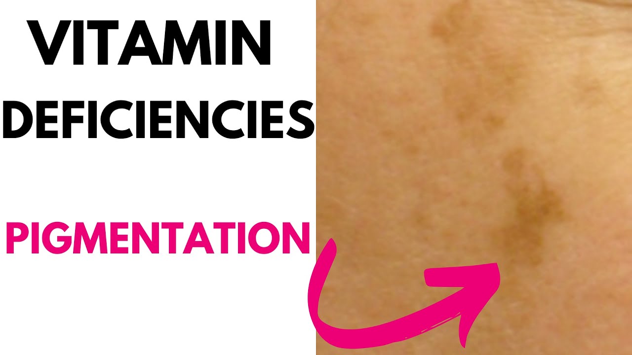 Vitamin Deficiencies  HYPERPIGMENTATION #goseechristy #shorts