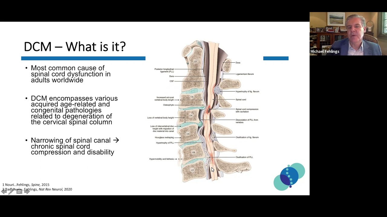 Degenerative Cervical Myelopathy Webinar - August 16, 2021