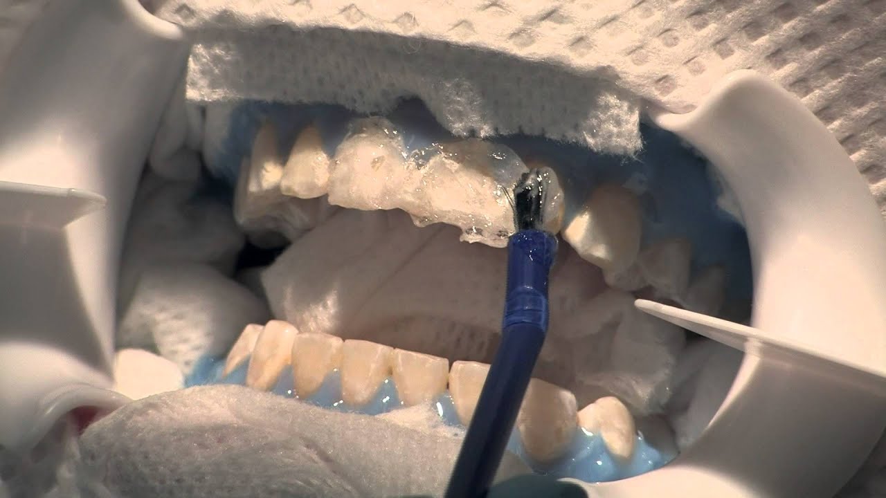 Blanqueamiento de Dientes en el Consultorio Dental