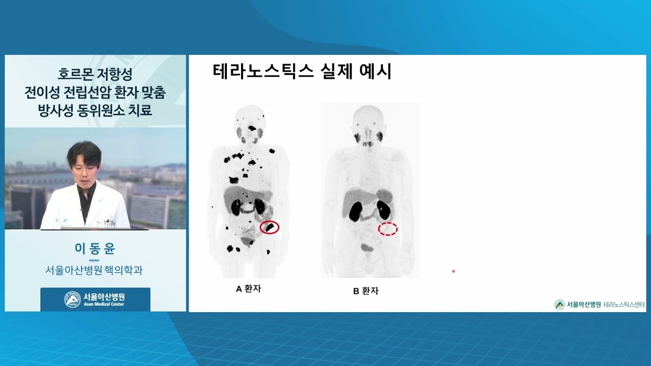 호르몬 저항성 전이성 전립선암 환자 맞춤 방사성 동위원소 치료 | 서울아산병원