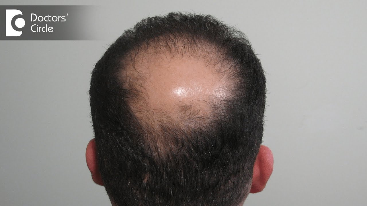 Why hair problems are so common nowadays? - Dr. Parthasarathi Dutta Roy