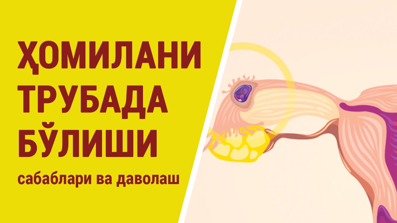Ҳомилани трубада бўлиши