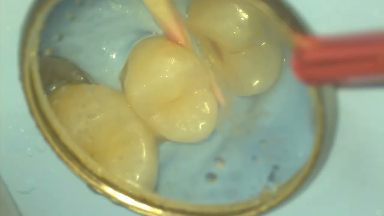 SRDC class II adhesive dentistrty