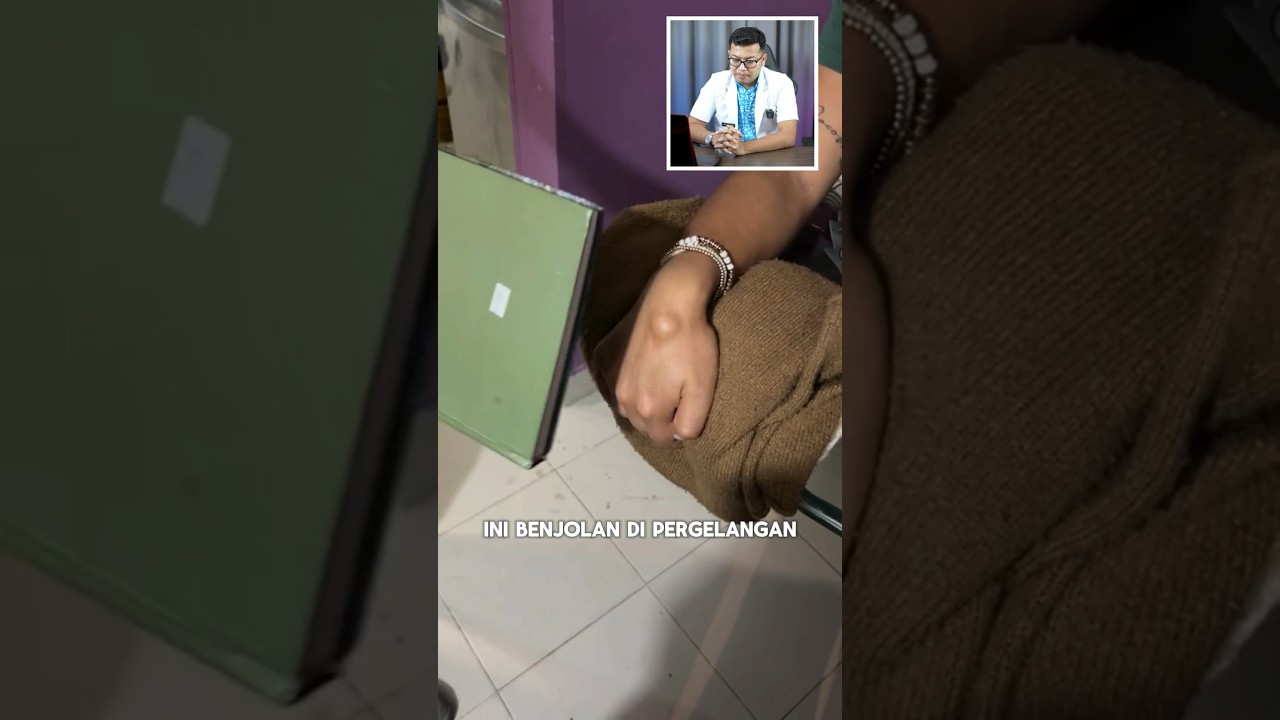 Benjolan di pergelangan tangan kista ganglion #kista #kistaganglion #benjolan #drsaddamismail