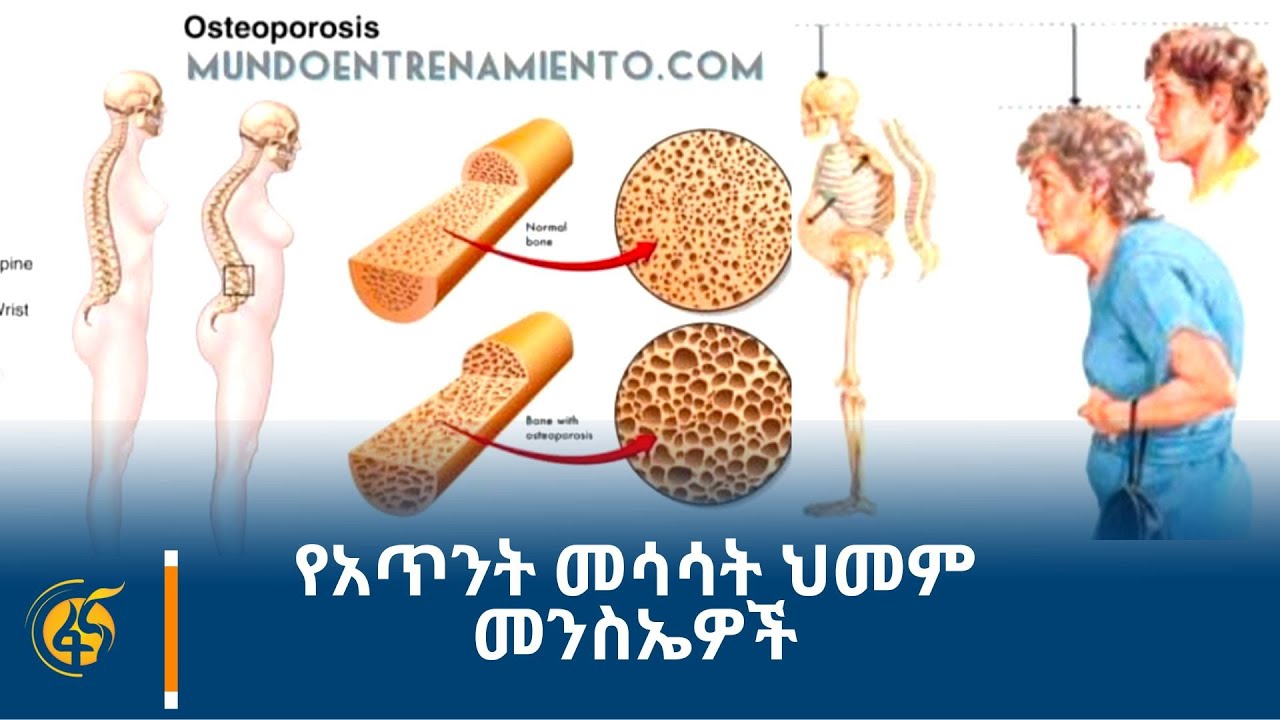 የአጥንት መሳሳት ህመም መንስኤዎች