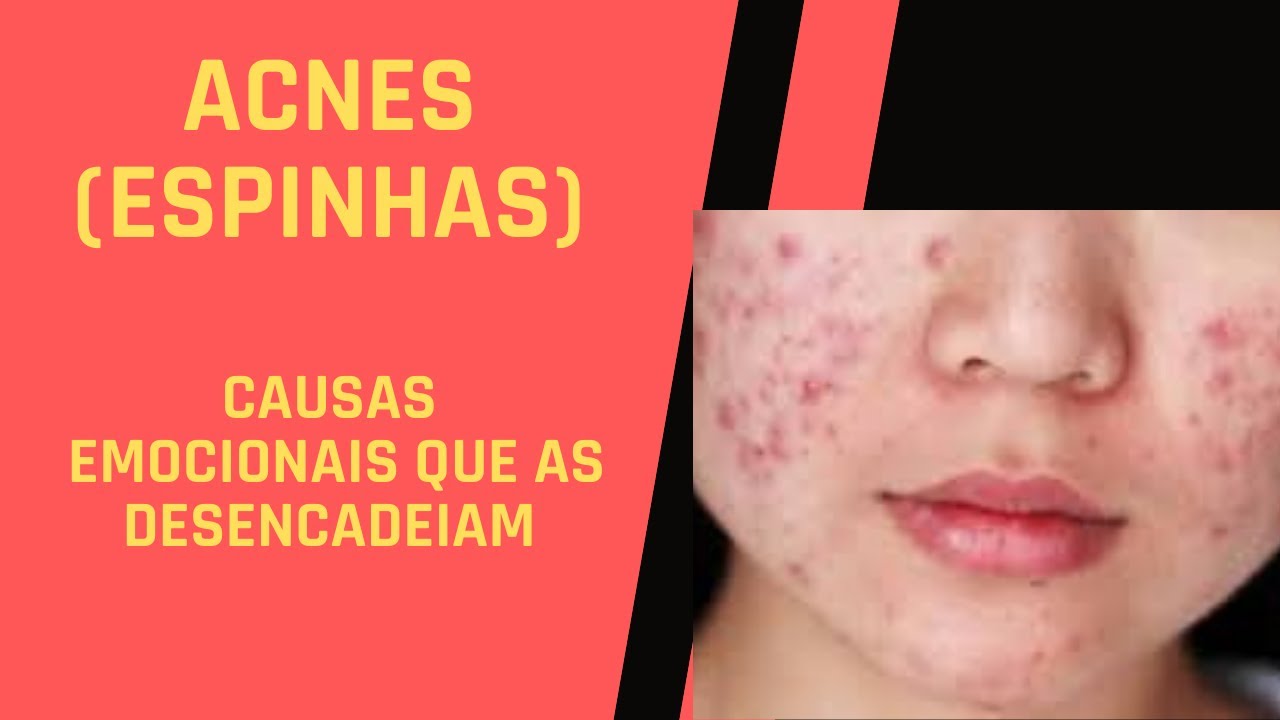 ACNES (ESPINHAS): CAUSAS EMOCIONAIS QUE AS DESENCADEIAM