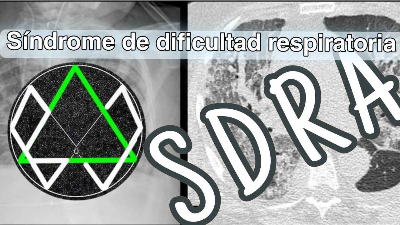 SDRA Síndrome de dificultad respiratoria