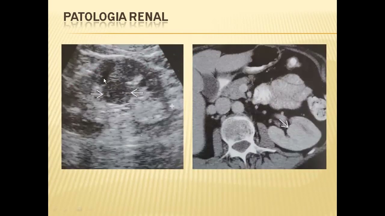 PATOLOGIA RENAL