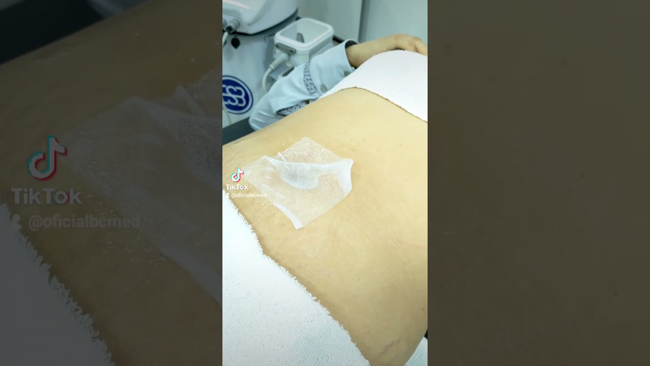 Criodermis Full a criolipólise de placas da Medical San 😍 #BCMED #esteticacorporal