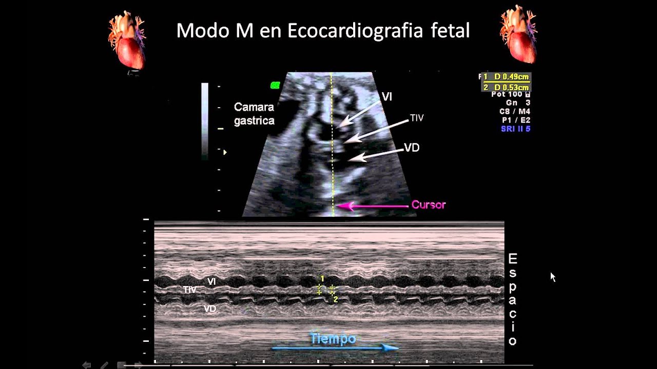 Ecocardiografía fetal: Ultrasonido en Modo M para Evaluar el corazón fetal