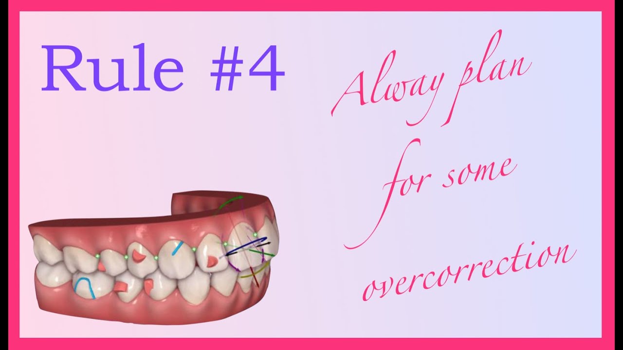 Overcorrection and whereabouts - Invisalign Mini Course 5 of 8