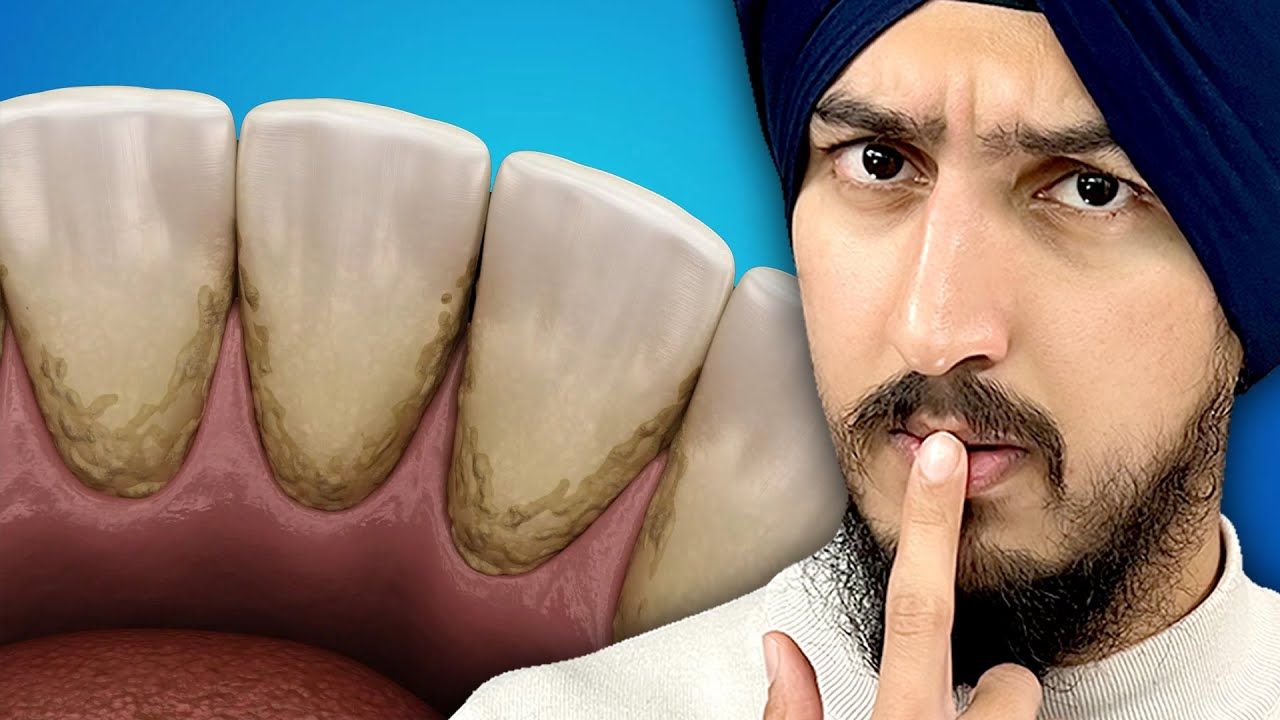 Why is it IMPOSSIBLE to Get These Teeth Clean?