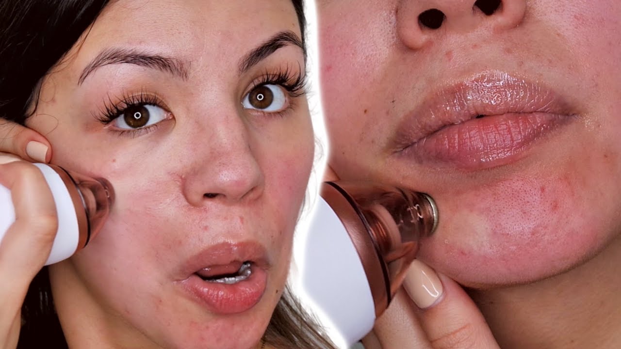 MICRODERMABRASION FACIAL AT HOME | BEFORE AND AFTER RESULTS
