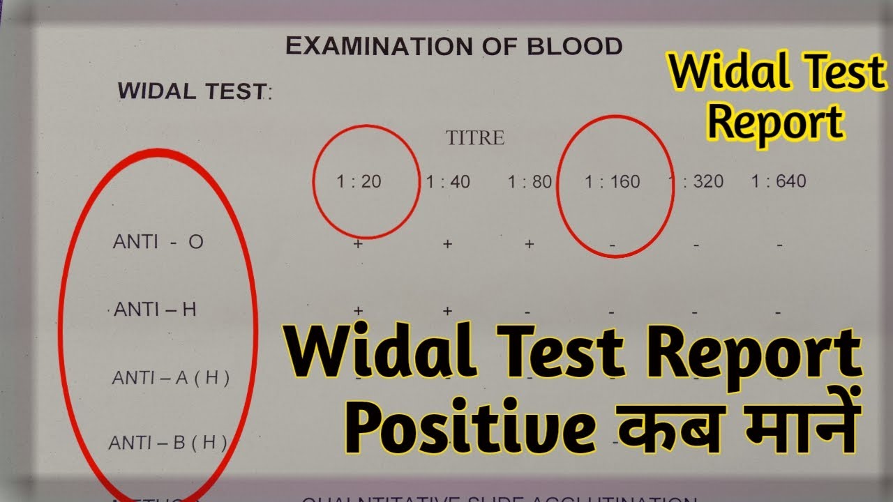 Typhoid Blood Test | Widal Test Report Reading | Widal Test In Hindi | Widal Test Report Kaise Dekhe