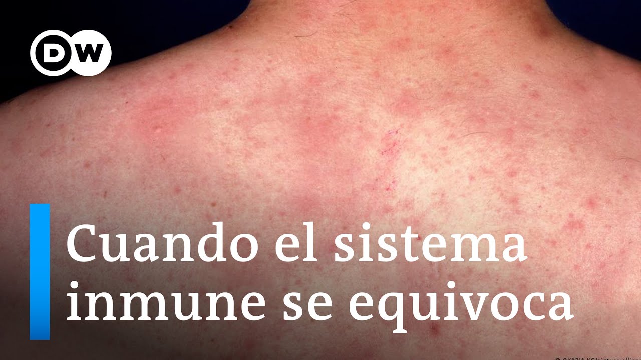 La alergia: un error del sistema de defensa del organismo