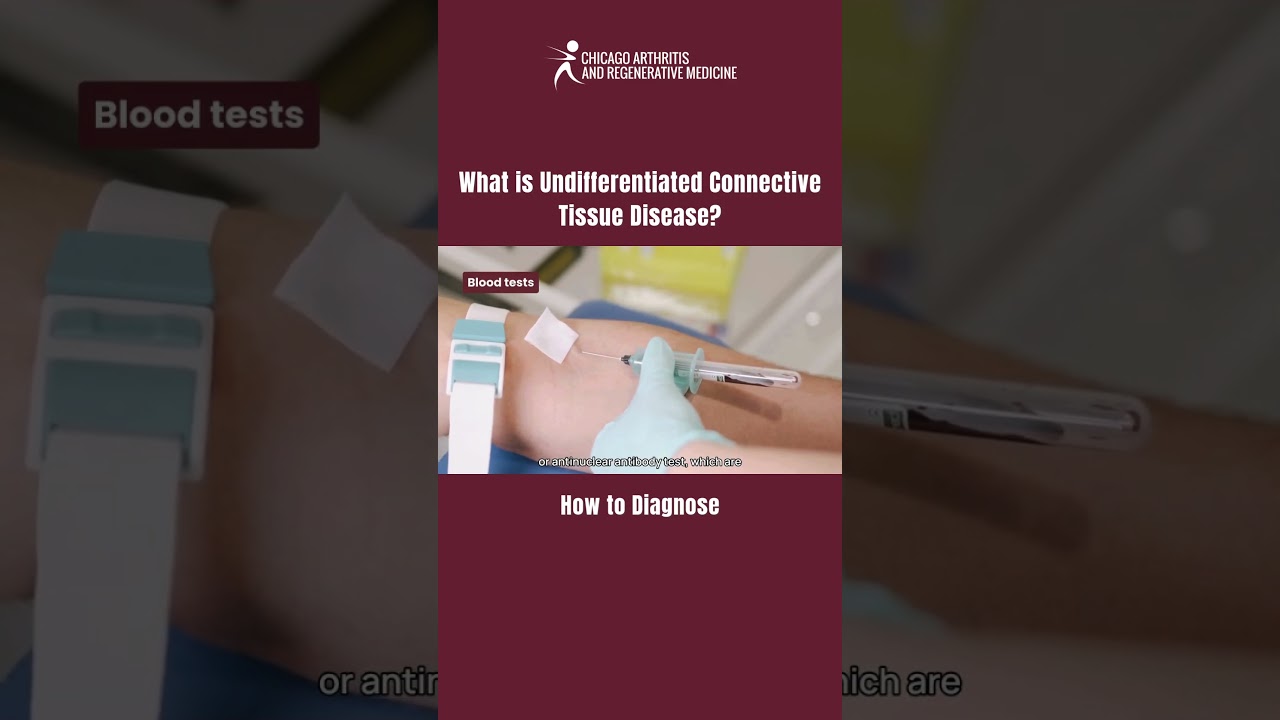 How to diagnose UCTD (Undifferentiated Connective Tissue Disease)? #Rheumatology