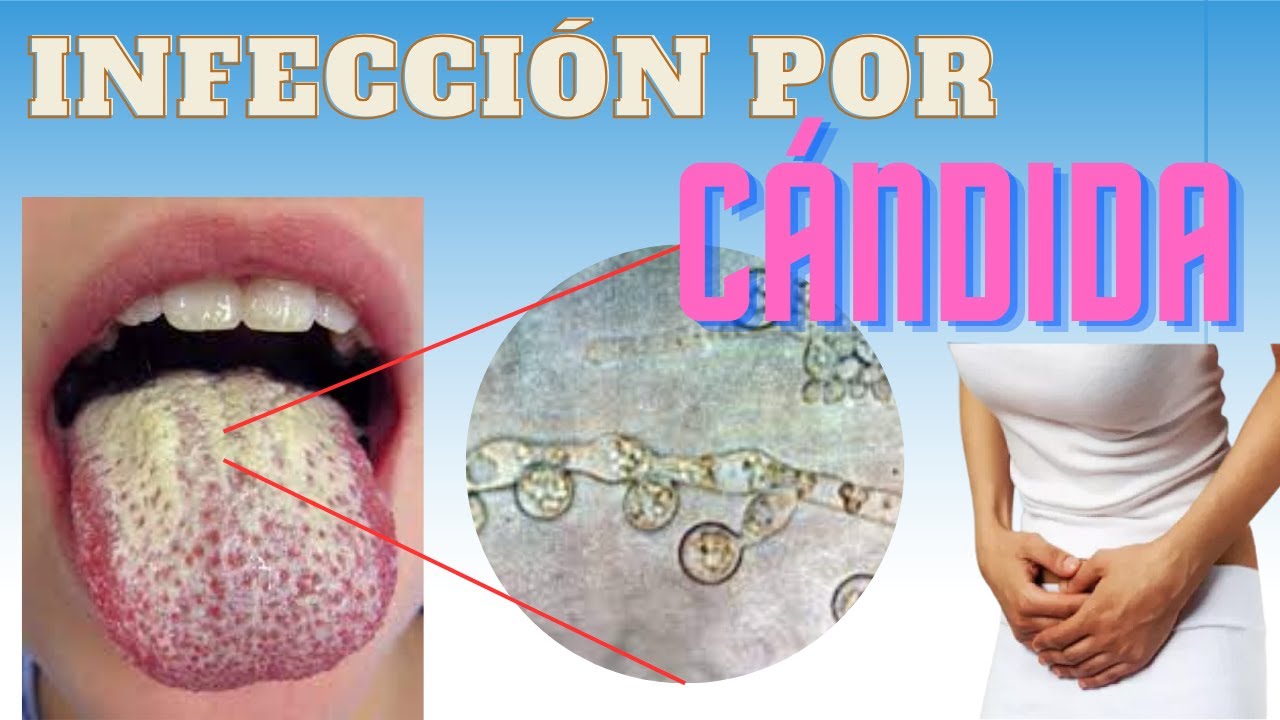 Infección por cándida y candidiasis. ¿Qué es?
