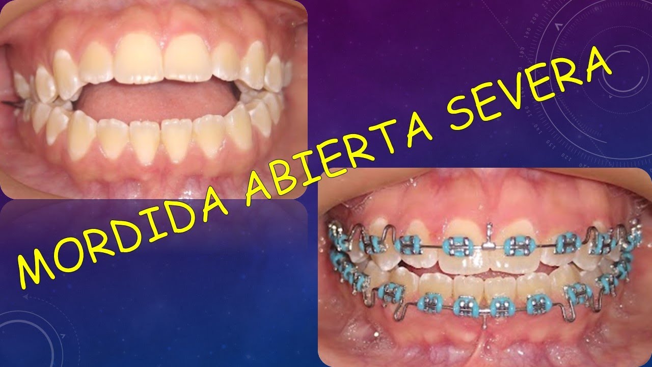 ¿Como solucionar una mordida abierta compleja? 😎 con arcos gummetal.
