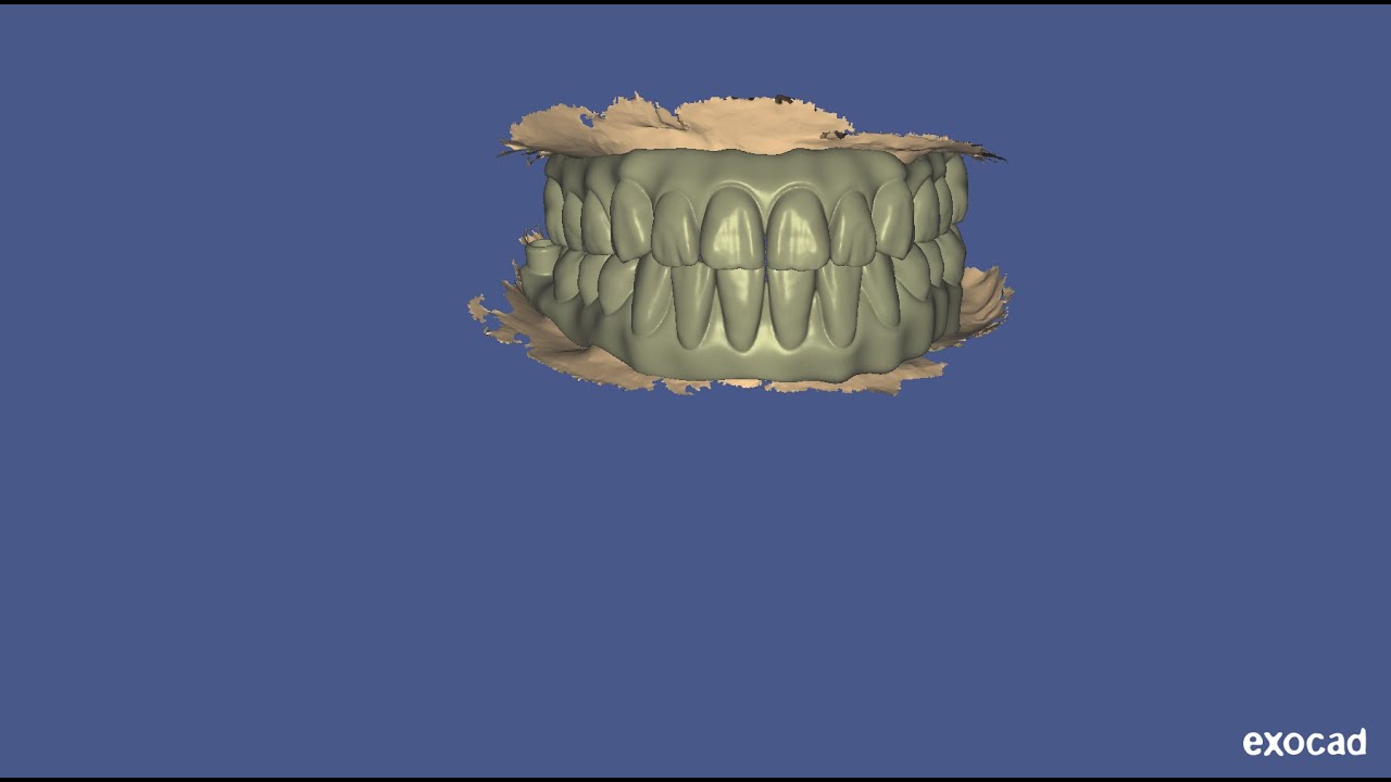 How to fmr designing for multiunit implants in upper & lower arch - best laser dental clinic