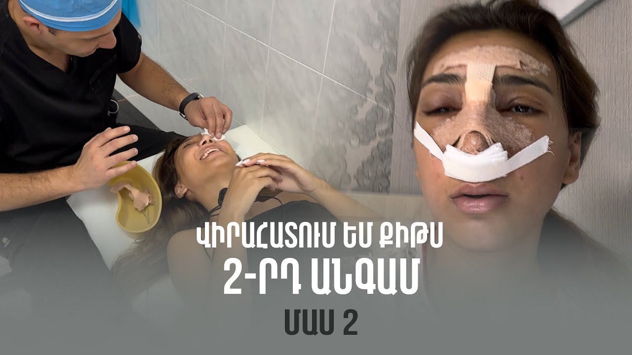 Վիրահատում եմ քիթս 2-րդ անգամ, մաս 2