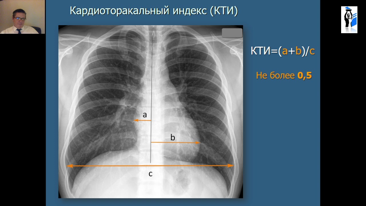 Лучевая диагностика заболеваний ССС. Лекция А.В. Капишникова