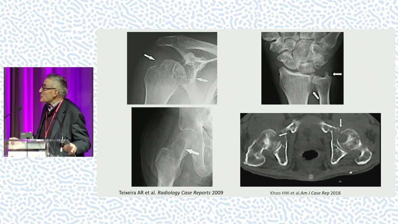 Amylose et atteintes rhumatologiques : reconnaître, confirmer, suivre