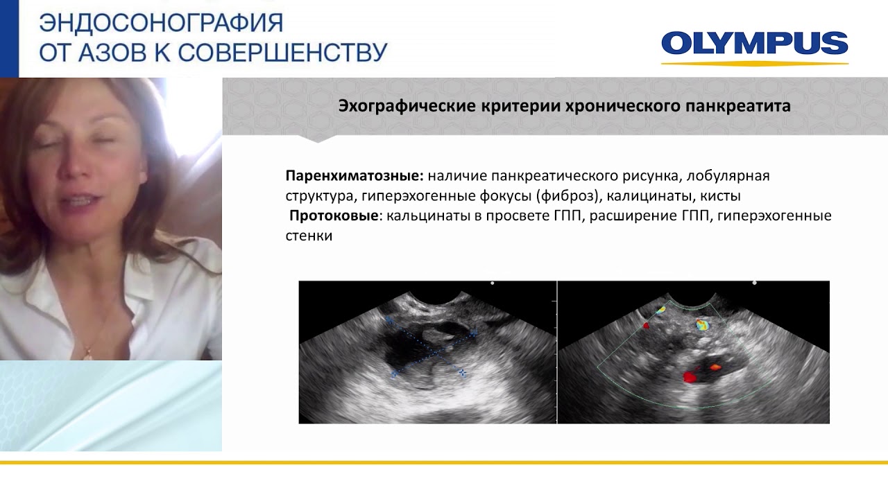 Эндосонография в дифференциальной диагностике солидных новообразований поджелудочной железы