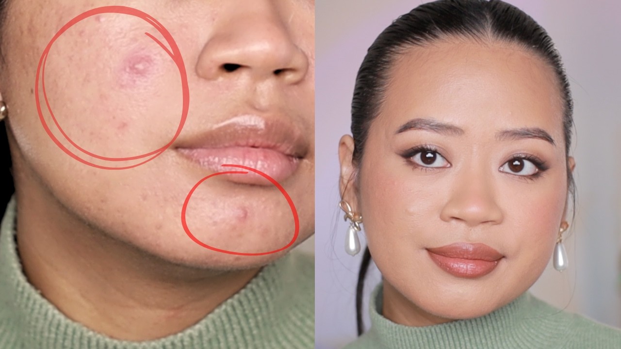 How to cover cystic acne ALL DAY with makeup (no filter)