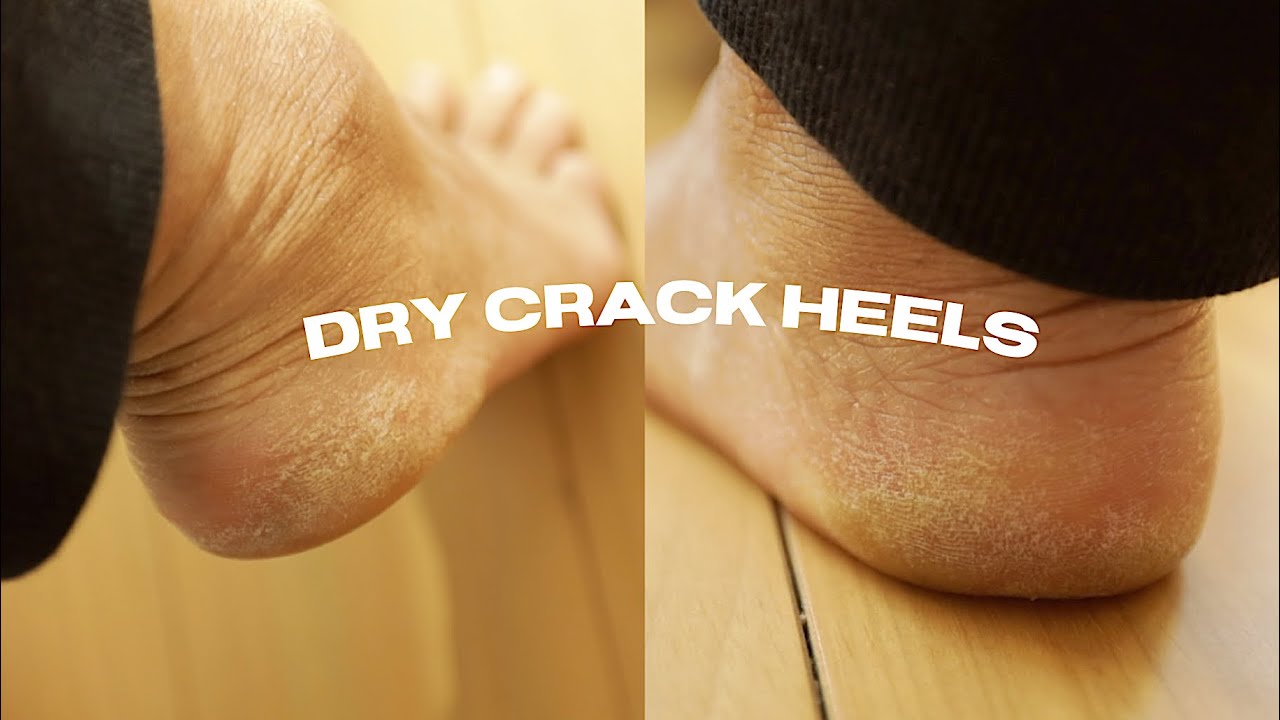 my Callus Removal Pedicure At Home | abetweene