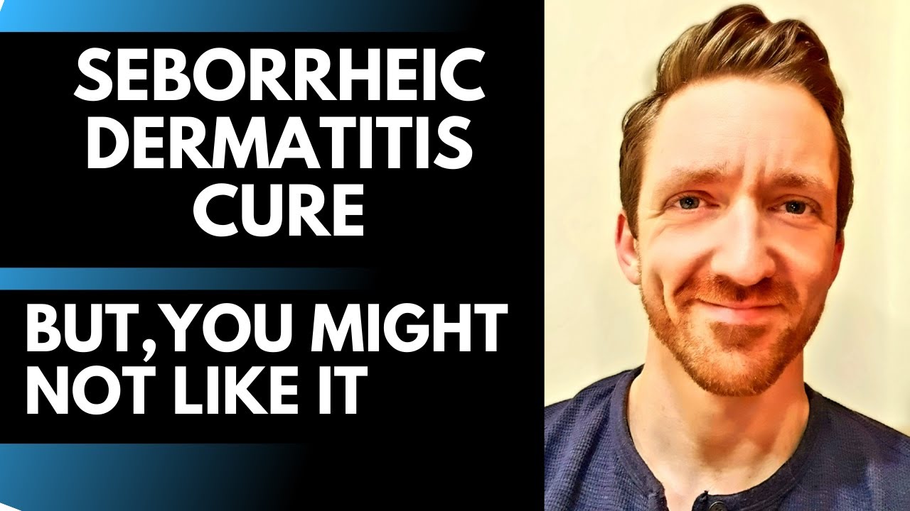 Seborrheic Dermatitis Cure - THIS WORKS! But You Might Not Like It.