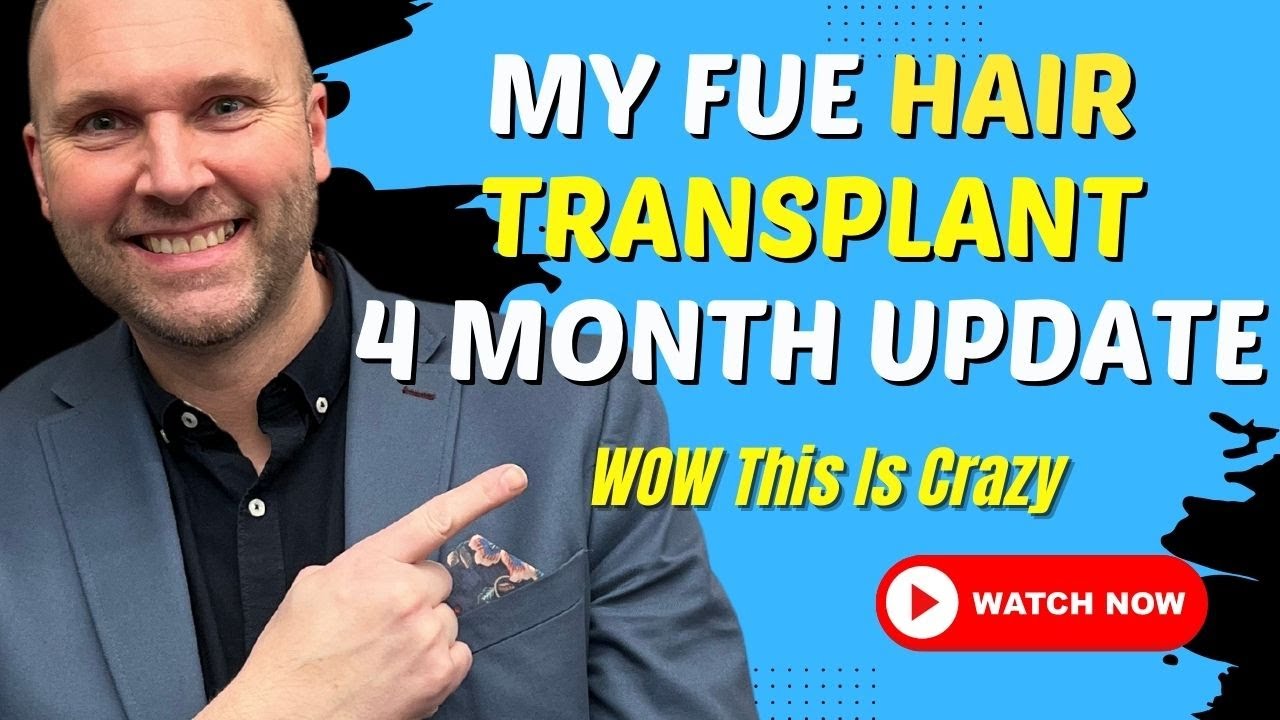 My FUE Hair Transplant 4 Months Update, WOW This Is Crazy!