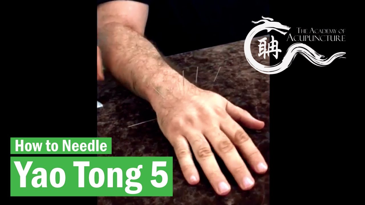 How to needle Yao Tong 5 如何針灸 #腰痛五 #eileenhan #theacademyofacupuncture Malaysia 2018