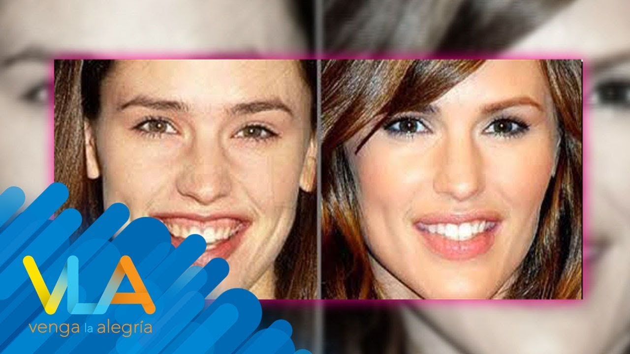 ¡Embellece tu sonrisa con esta pequeña cirugía! | Venga la Alegría