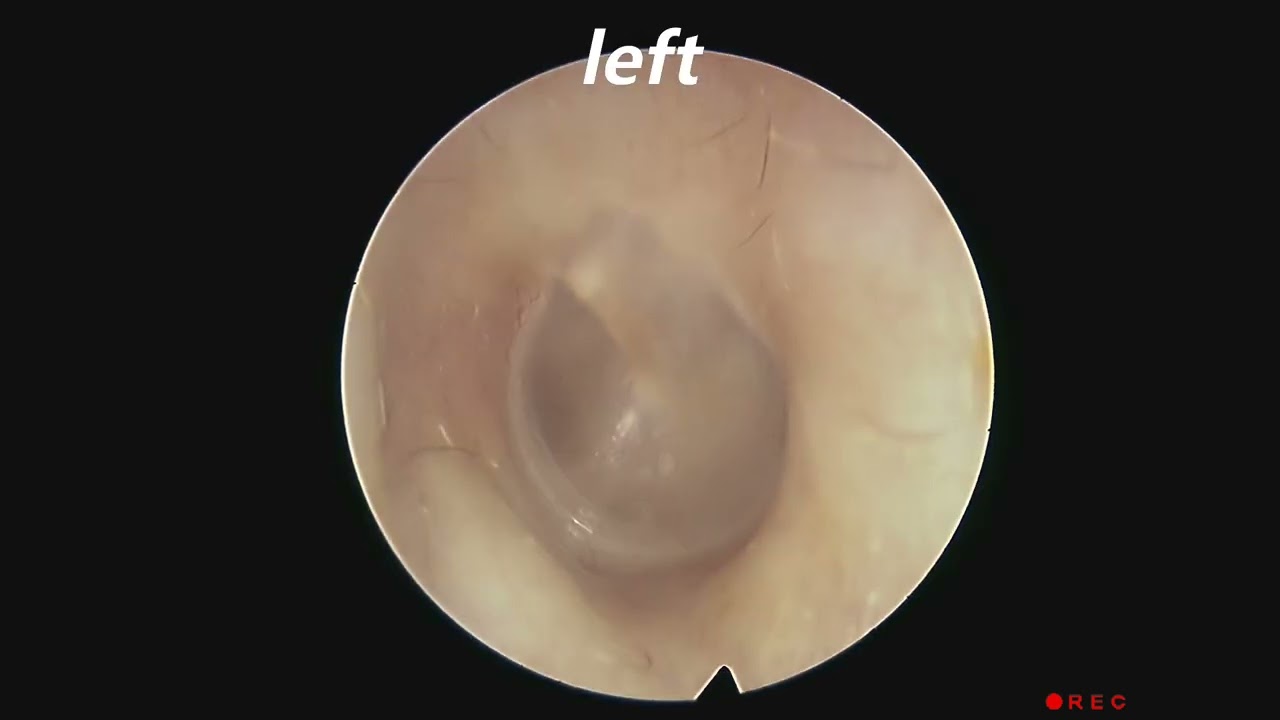 Endoscopy of Normal Eardrum