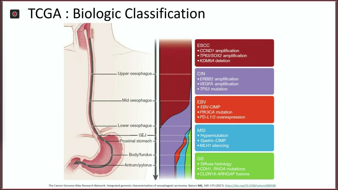 Cancer at a Crossroads: Evolution in Management of GE Junction Adenocarcinoma - Eihab Abdelfatah