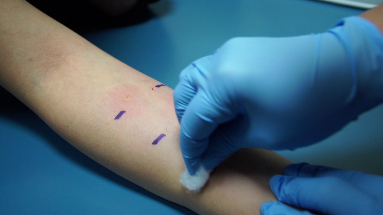 DERİ PRICK TESTİ